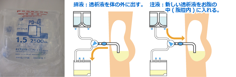 川島病院 腹膜透析の手順4
