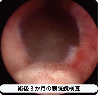 加熱不要ウォータージェットによる切除