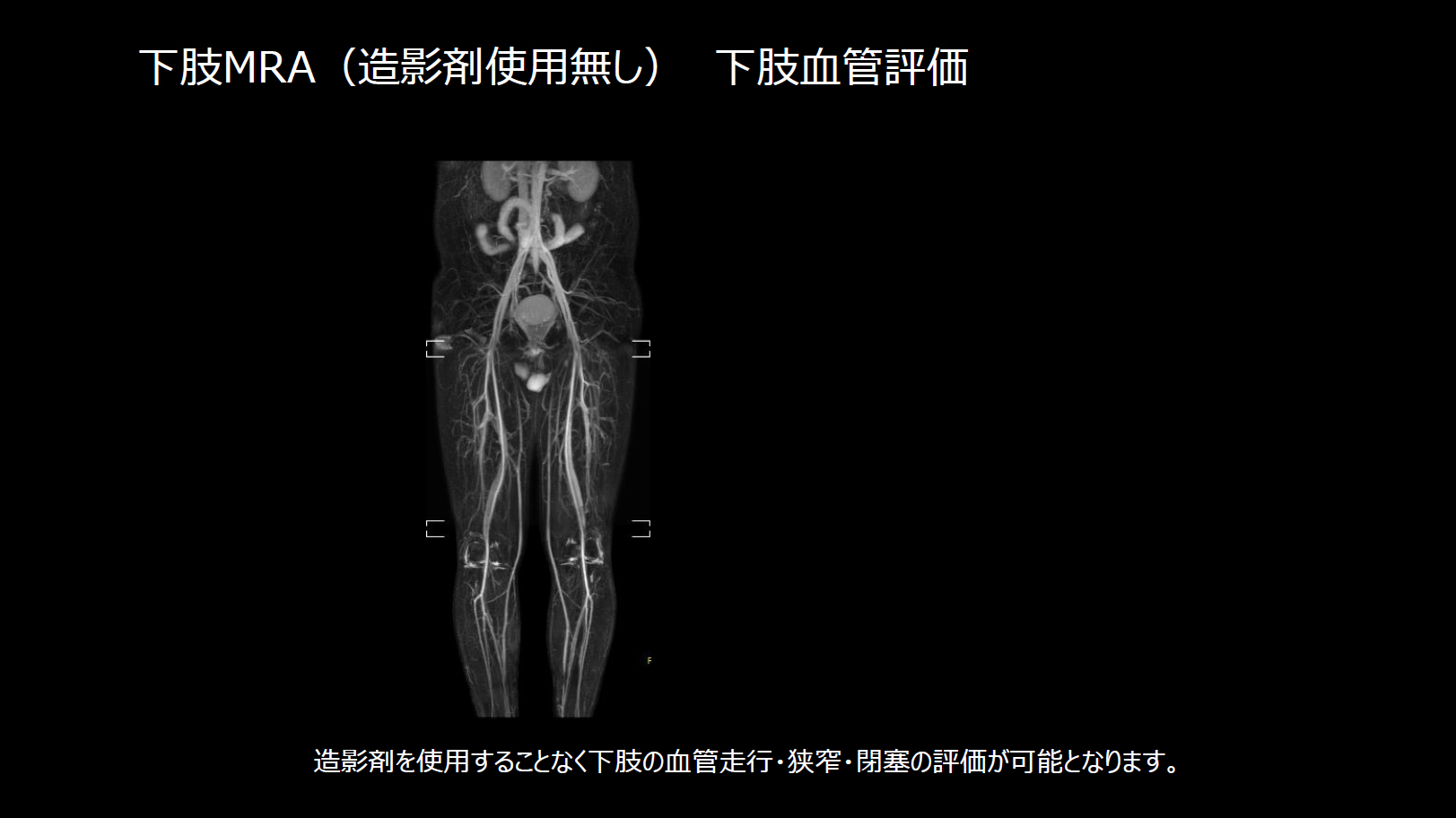 下肢MRA （造影剤使用無し） 下肢血管評価
