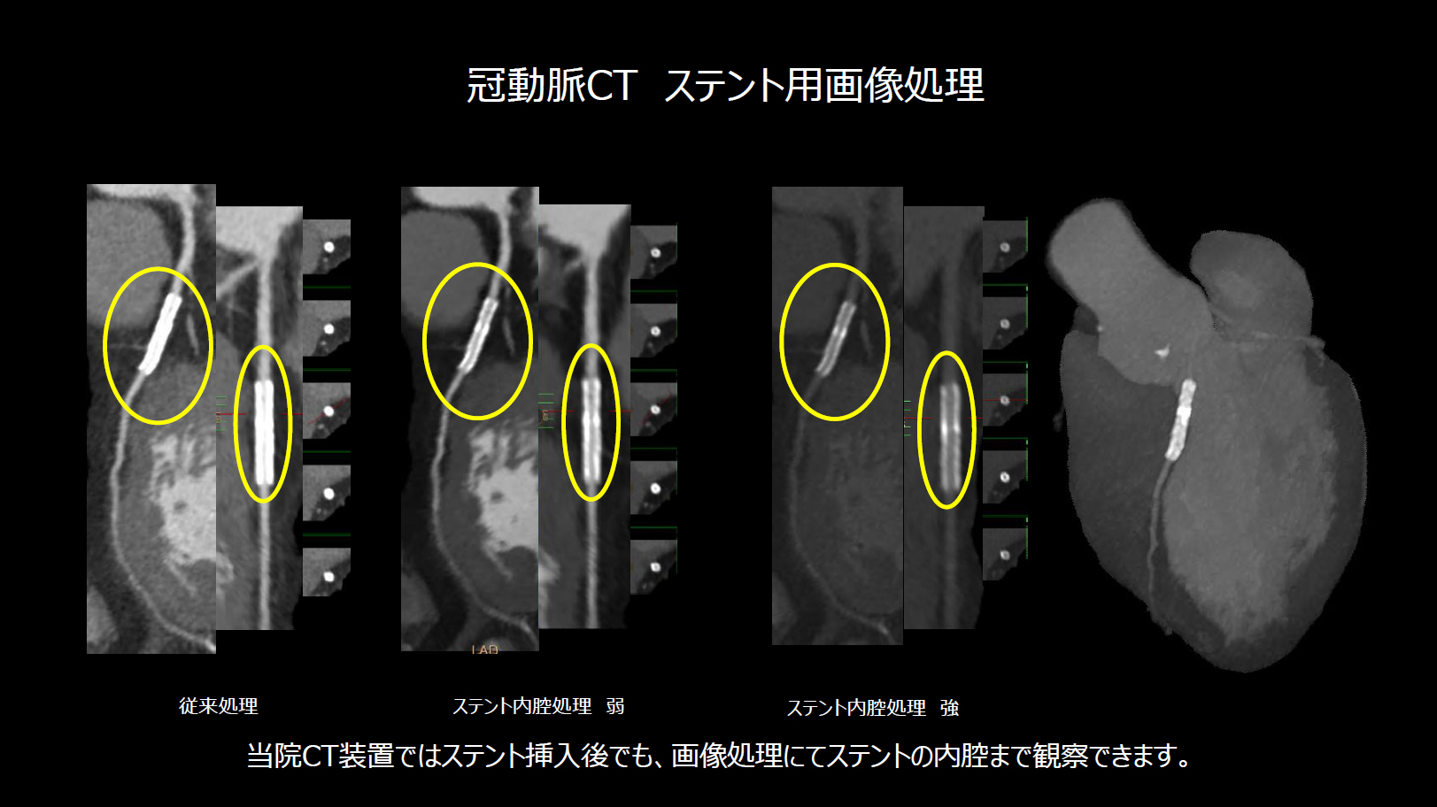 冠動脈CT ステント用画像処理